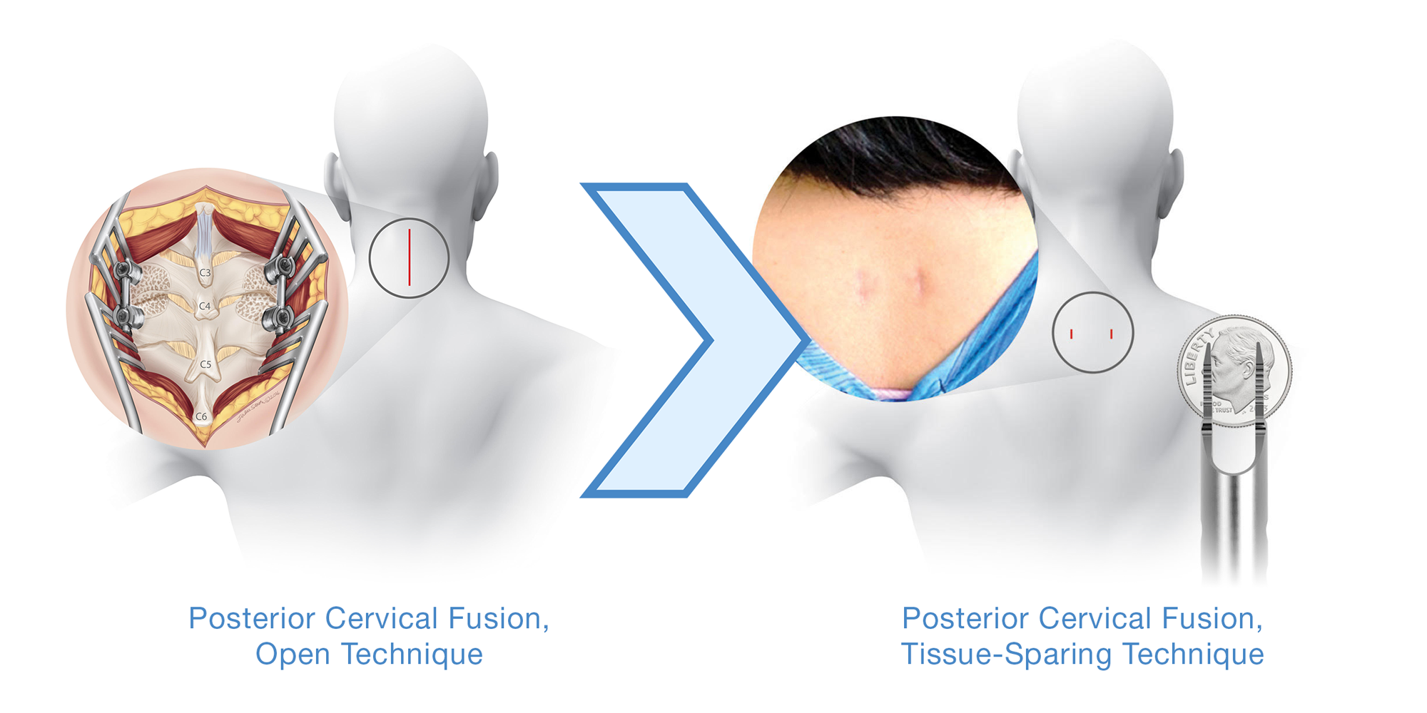 Evolution of Posterior Cervical Fusion & The Adoption of Less Invasive Techniques